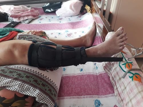 A patient's leg supported in a knee brace during home care