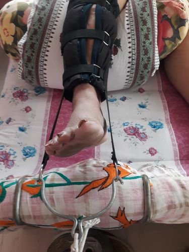 Knee immobiliser brace on a patient recovering at home